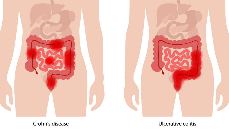 Understanding Crohn’s Disease